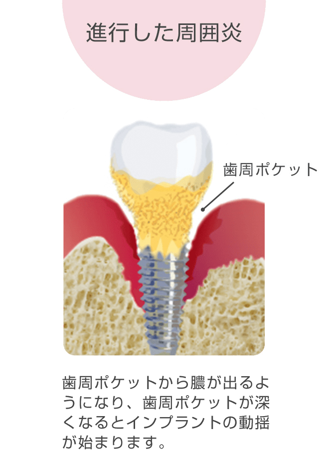 レベル２